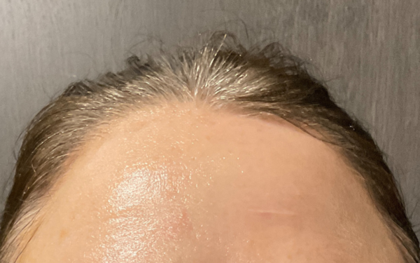 Halo-Patient-9 | Before Laser Services