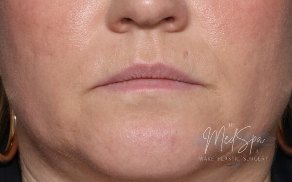 Lip filler before picture