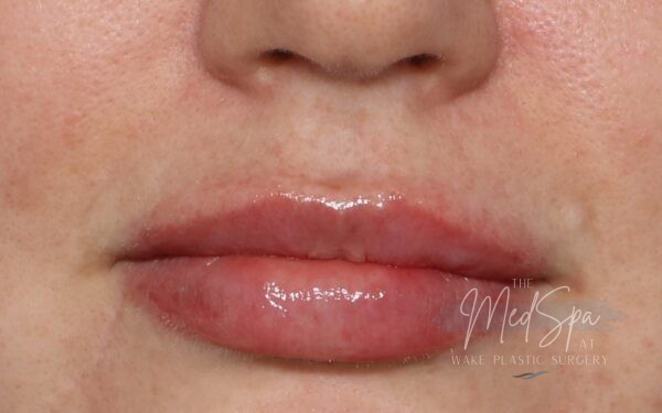 Lip-Filler-Patient-2 | After Dermal Filler