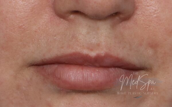 Lip-Filler-Patient-2 | Before Dermal Filler