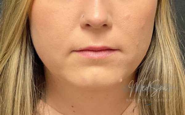 Lip-Filler-Patient-11 | Before Dermal Filler