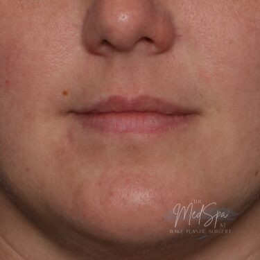 Lip filler before picture