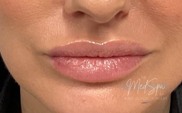 Lip-Filler-Patient-8 | After Dermal Filler