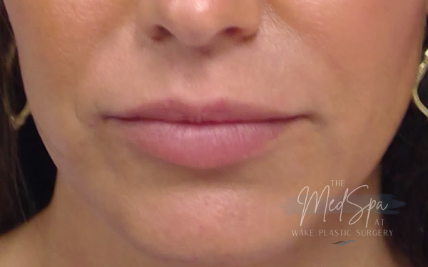 lip filler before picture