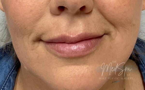 Lip-Filler-Patient-10 | After Dermal Filler