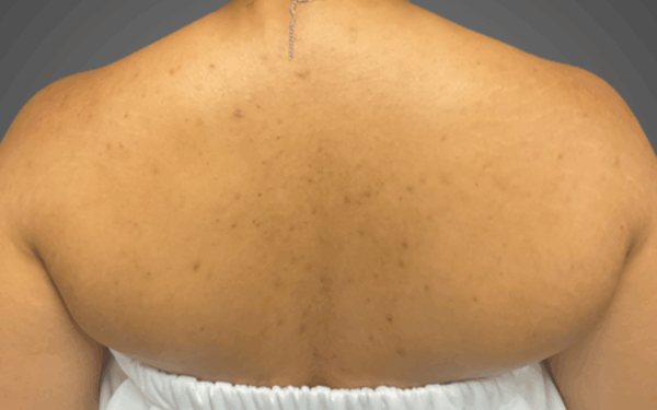 Patient-3 | After Chemical Peel
