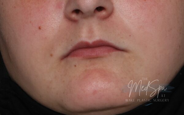 Lip filler before picture