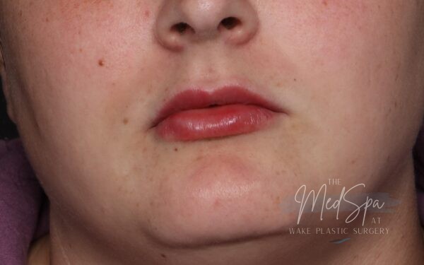 Lip filler after picture